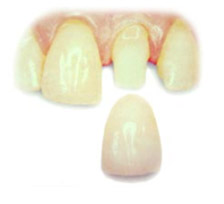 Crowns at Claremorris Dental Care