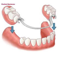 Dentures at Claremorris Dental Care