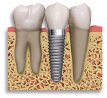 Implants at Claremorris Dental Care