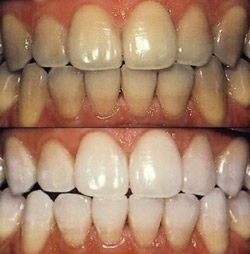 Whiter Teeth at Claremorris Dental Care